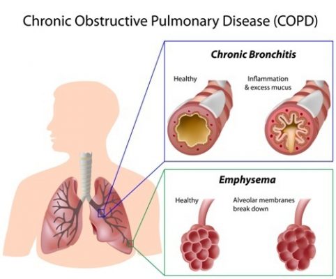 Chronic,Obstructive,Pulmonary,Disease,(copd)